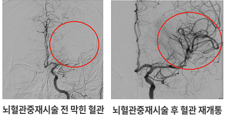 뇌혈관중재시술 전후 이미지