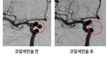 코인색전술 전후 이미지