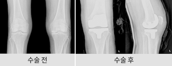 수술 전후 이미지