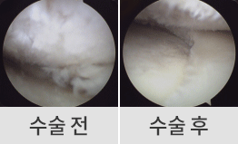 수술 전후 이미지