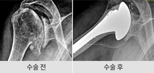 수술 전후 이미지