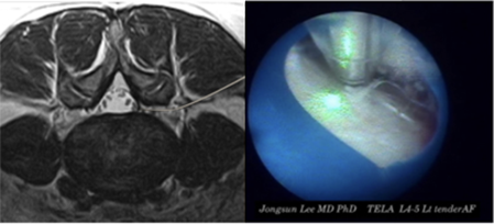내시경적 경막외강 신경근 성형술 이미지