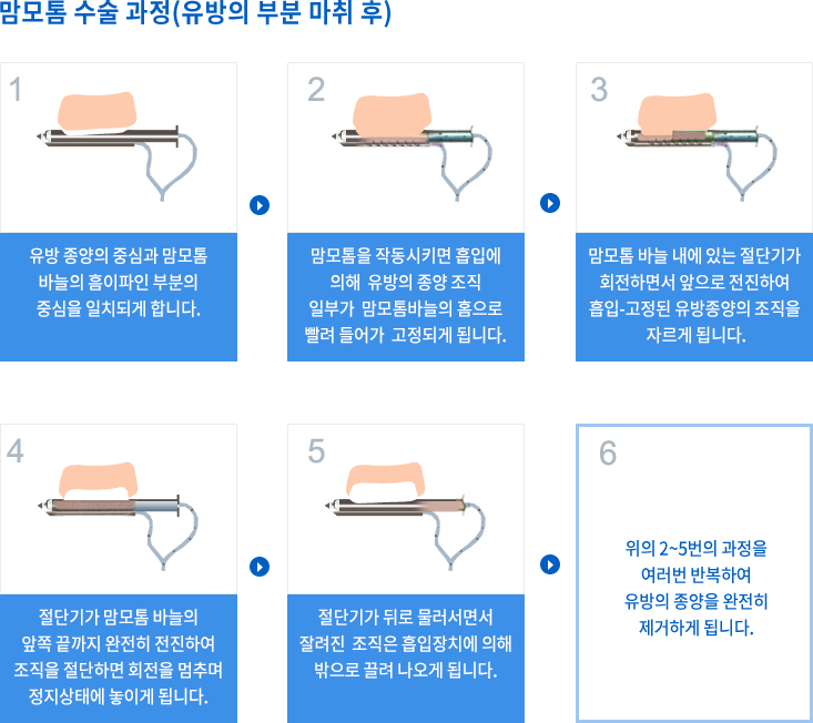 맘모톰 수술과정(유방의 부분 마취 후)